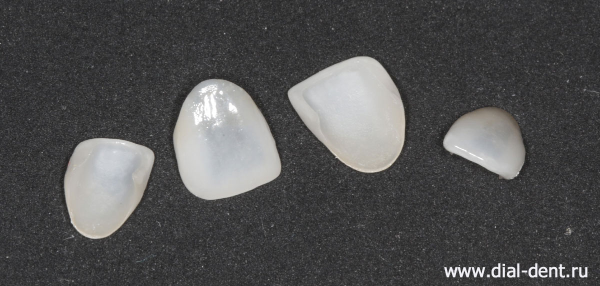 керамические виниры для зубов