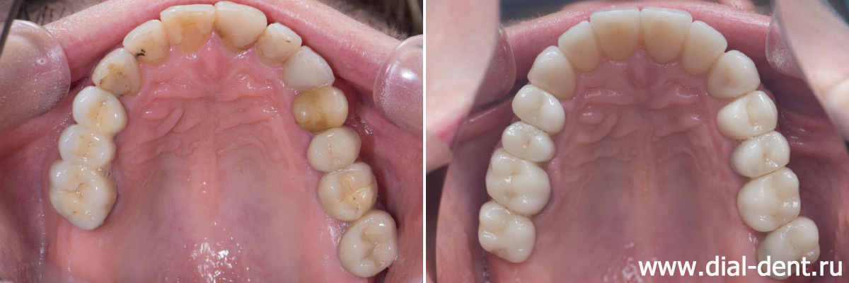 зубы до и после протезирования