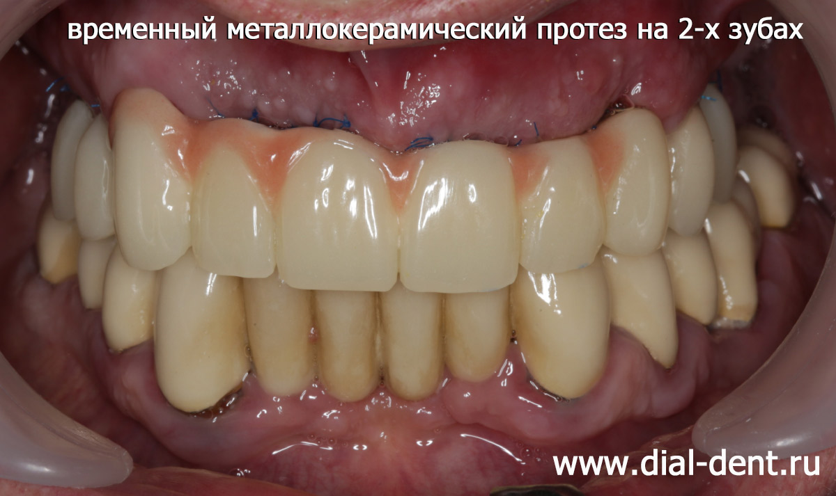 временный металлокерамический протез на 2-х опорных зубах