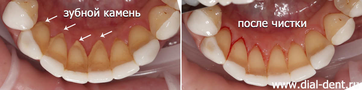 снятие налета и удаление зубного камня с помощью профессиональной гигиены зубов