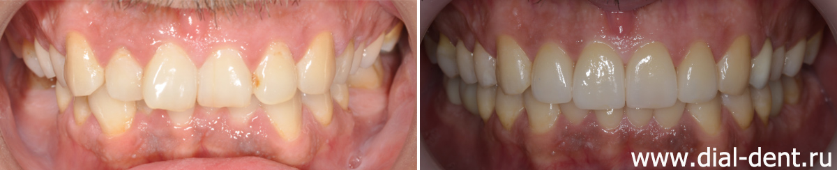 вид зубов до и после комплексного лечения
