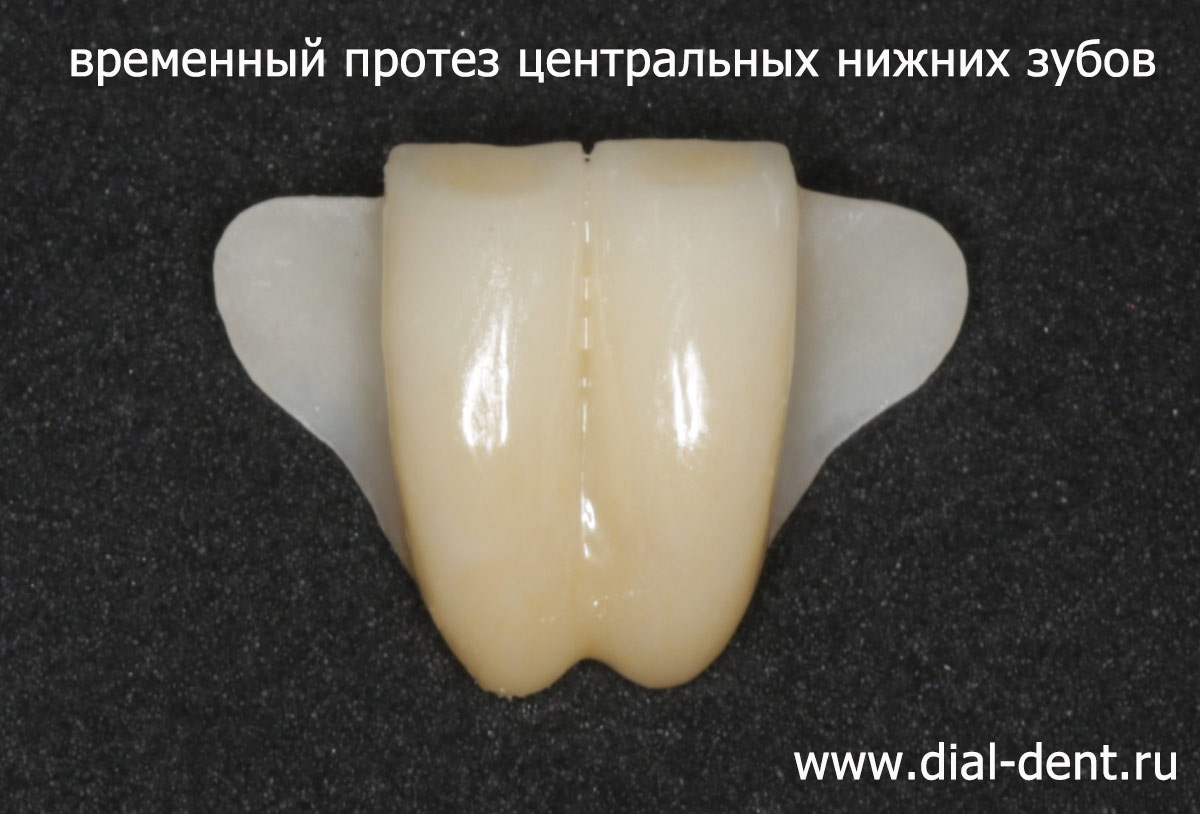 керамический протез двух центральных нижних зубов