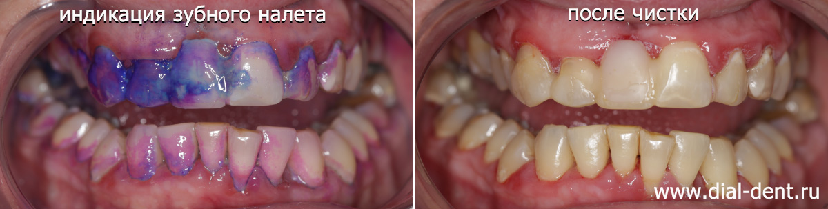 индикация налета до чистки и вид зубов после чистки