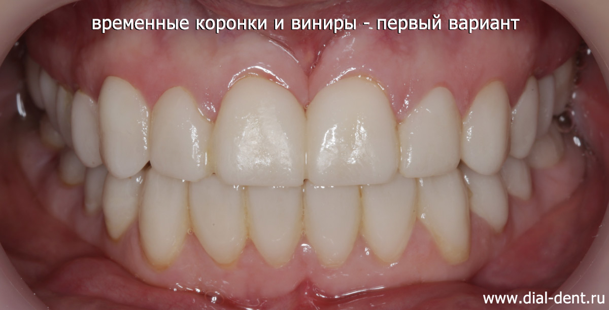 временные коронки, установленные сразу после подготовки зубов