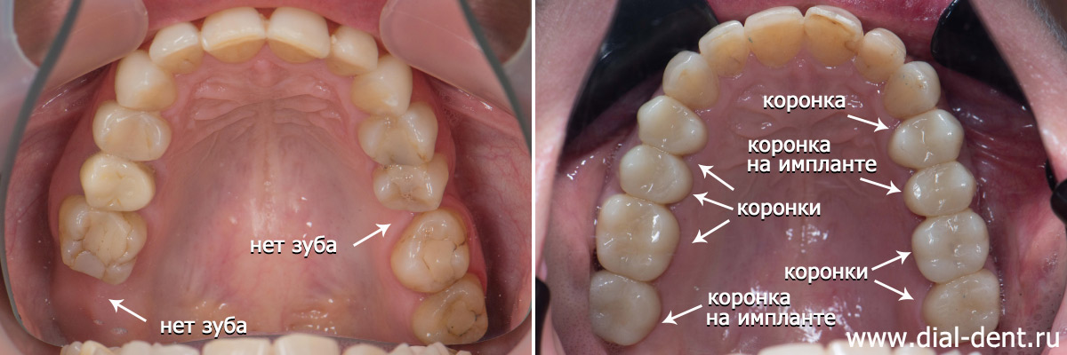 верхние зубы до и после комплексного лечения с протезированием