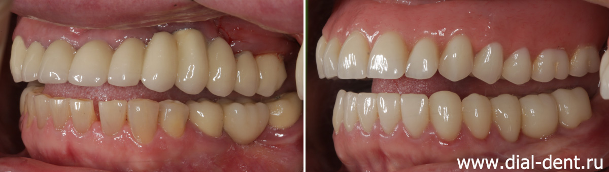вид слева до и после протезирования зубов