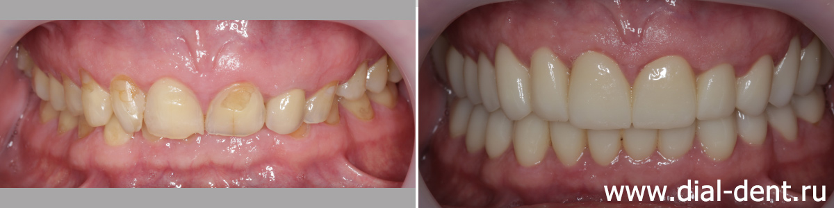 до и после протезирования зубов керамикой диоксид циркония