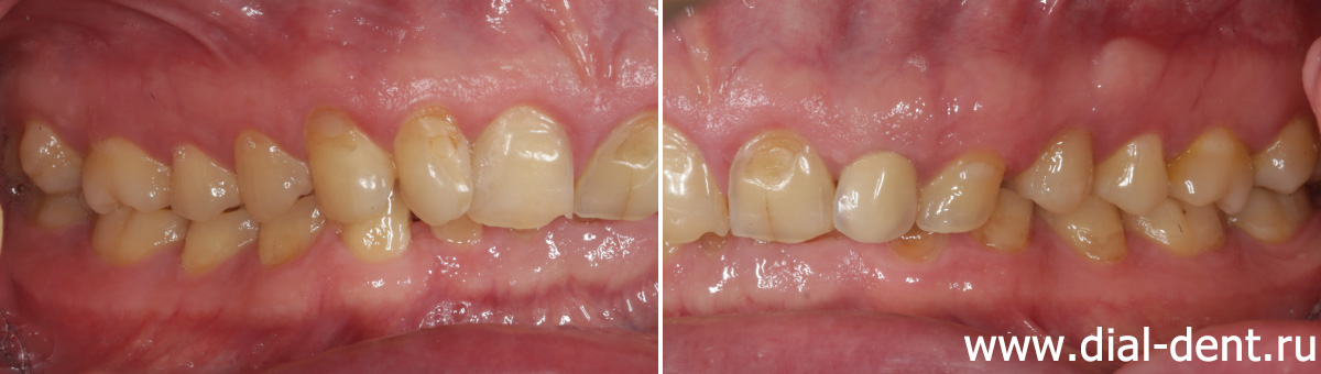 исходная ситуация - стертость зубов, дефекты на зубах
