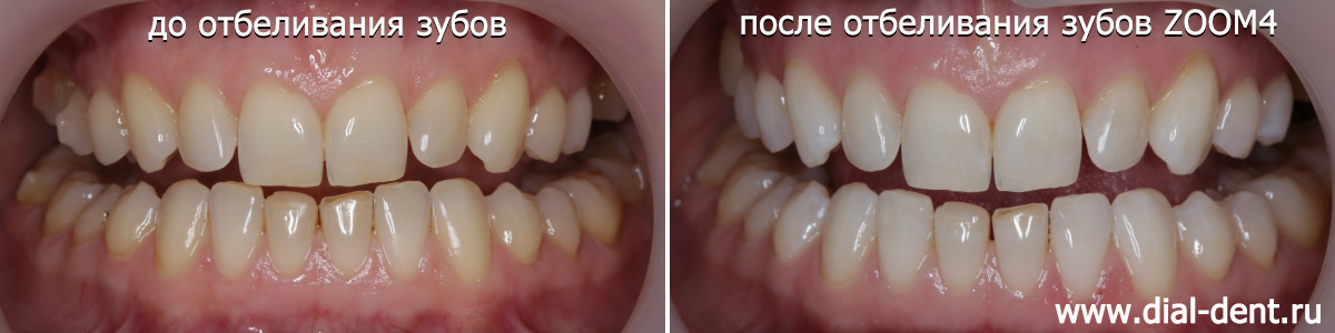 до и после отбеливания зубов