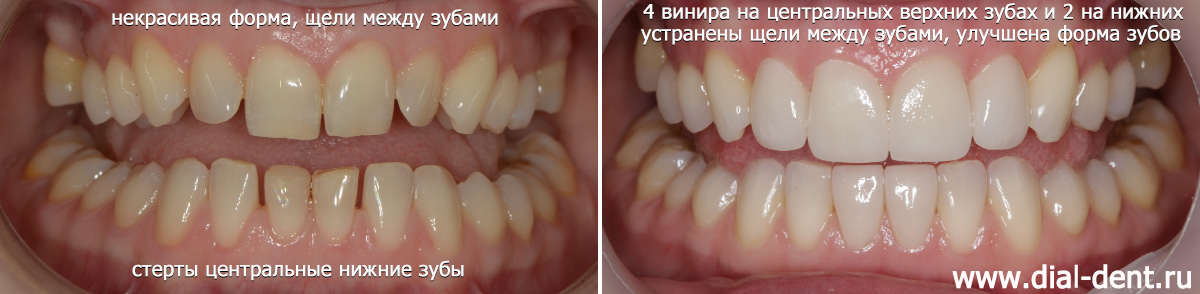 отбеливание зубов и реставрация передних зубов винирами