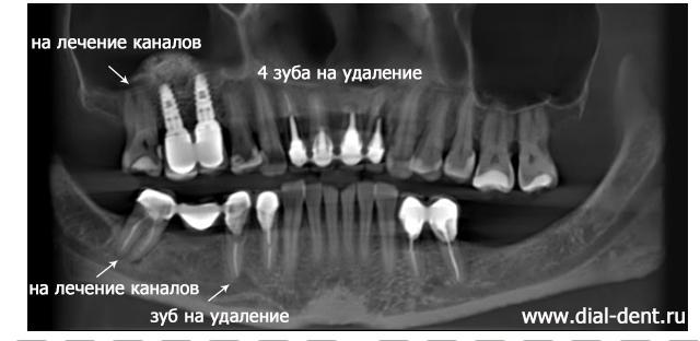 фрагмент КТ зубов до лечения