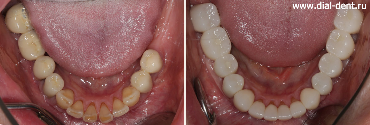 реставрация прикуса керамикой - нижние зубы