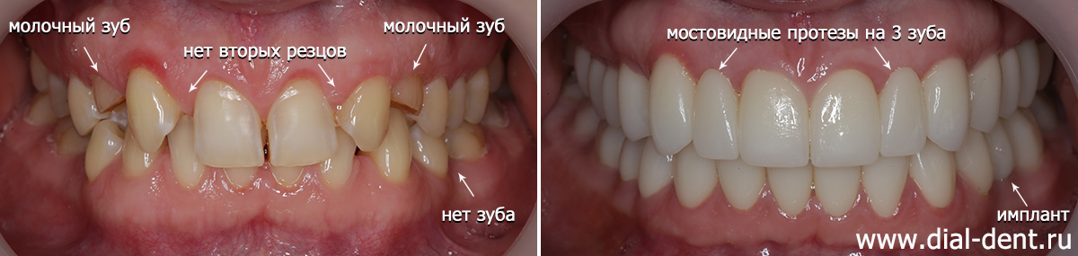 до и после комплексного лечения зубов с имплантацией и протезированием