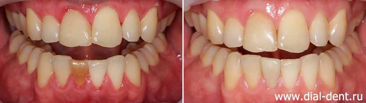 реставрация потемневшего переднего зуба виниром