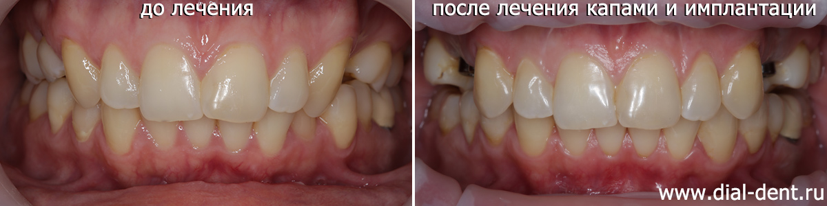 до и после ортодонтической подготовки и установки имплантов