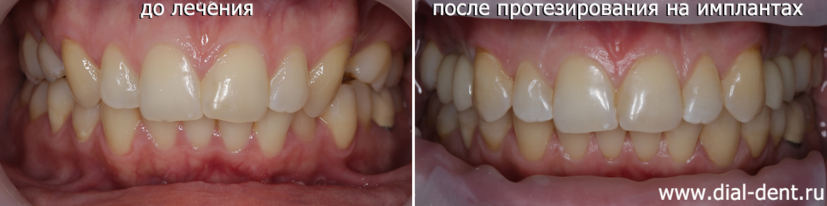 до и после протезирования на имплантах с ортодонтической подготовкой