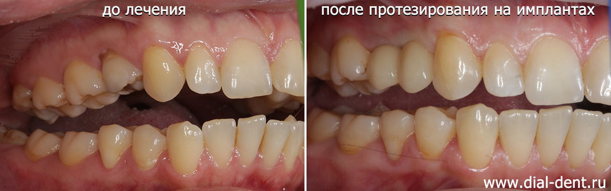 до и после лечения - вид справа