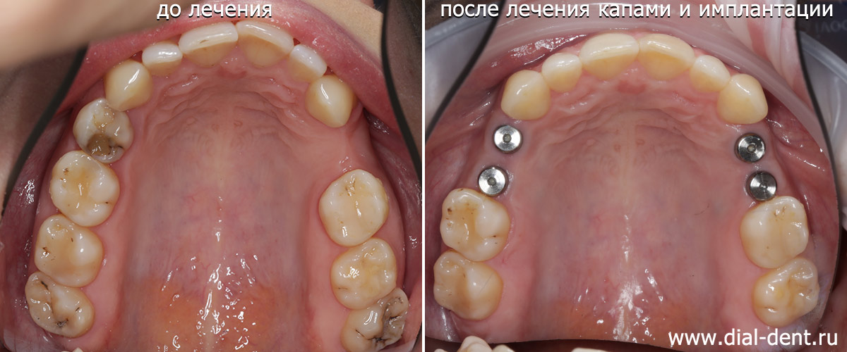 до и после ортодонтической подготовки и установки имплантов