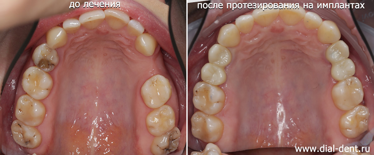 верхние зубы до и после протезирования на имплантах с ортодонтической подготовкой