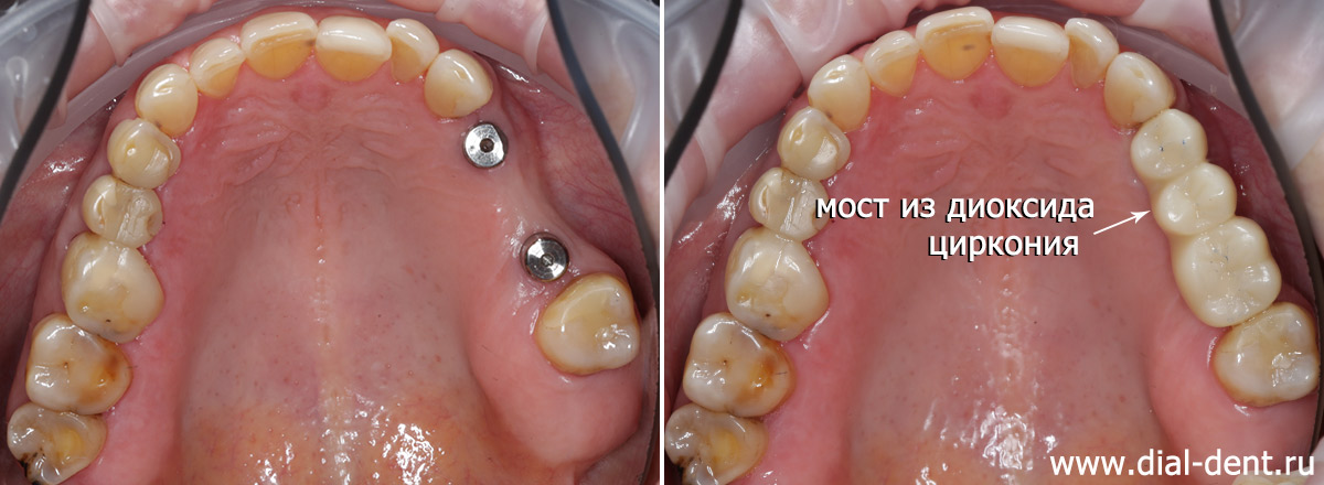 до и после лечения гайморита и протезирования зубов