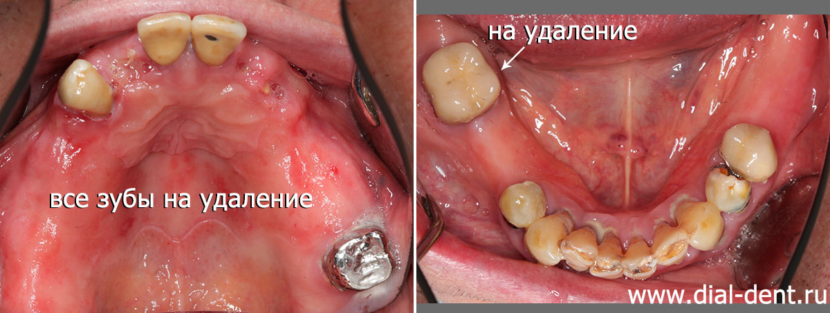 состояние зубов до лечения и удаления
