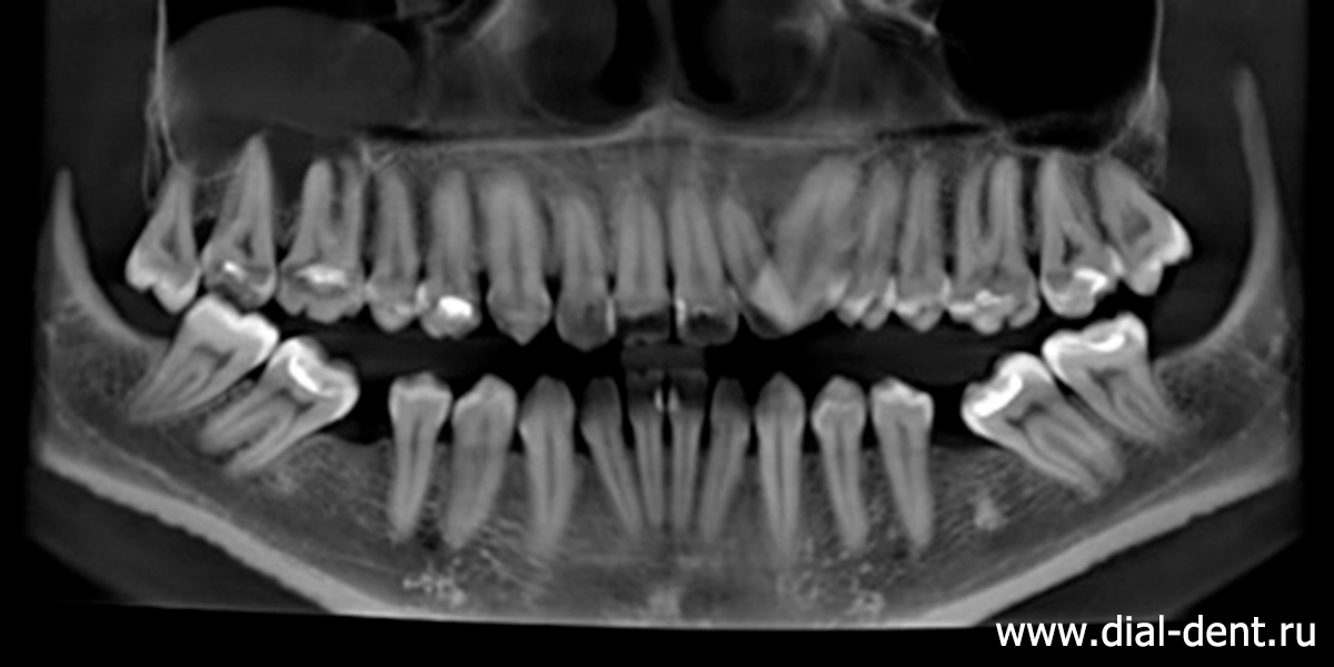 фрагмент компьютерной томографии зубов