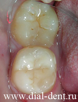 лечение кариеса зубов, пломба из светоотверждаемого материала