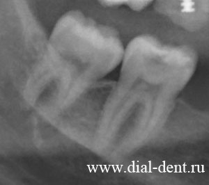 прицельный рентген зуба