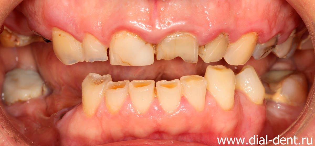 фото зубов при бруксизме - края зубов сильно стерты и сколоты