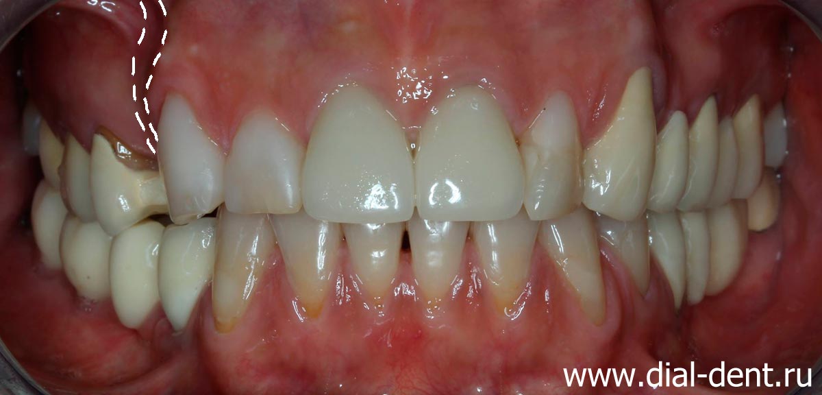 атрофия кости верхней челюсти после давнего удаления зуба