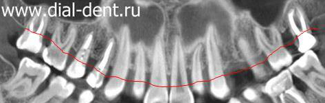 панорамный снимок зубов для определения уровня костной ткани