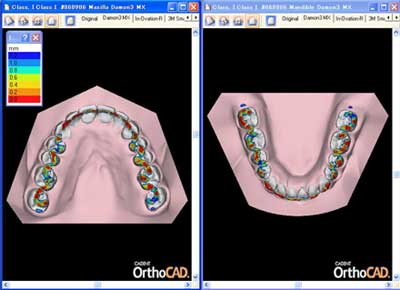 OrthoCad компьютерное моделирование в ортодонтии