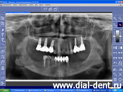 цифровой рентген в стоматологии