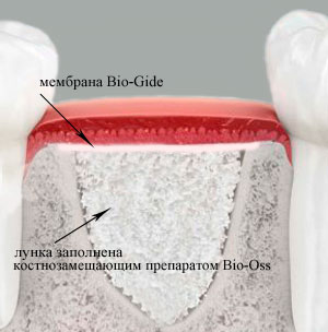 коллагеновая мембрана Bio-Gide и замещающий кость препарат Bio-Oss