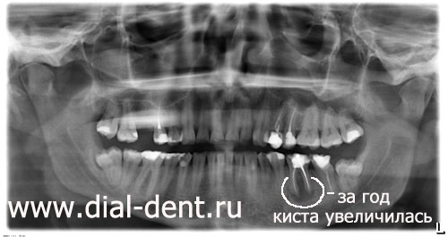 киста зуба через год (пациент не проводил лечение)