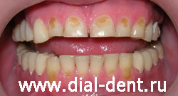 клиновидный дефект зубов и патологическая стираемость зубов
