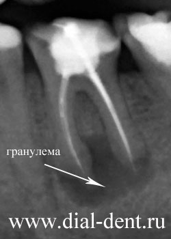 гранулема зуба на рентгене