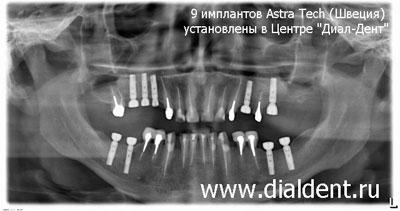 результат имплантации зубов на панорамном рентгене челюсти