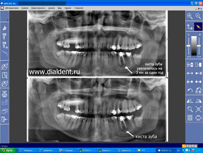рост кисты зуба, диагностика с помощью панорамного снимка зубов