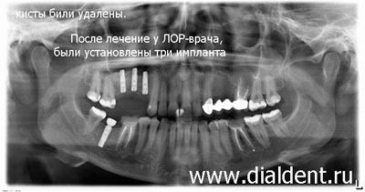 панорамный снимок зубов для ЛОР-диагностики