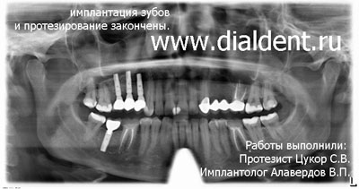 панорамный снимок зубов для оценки результатов лечения