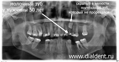 молочный зуб у взрослого пациента, панорамный снимок зубов