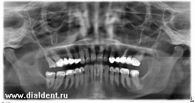 Панорамный снимок зубов Томск Черноморская Отбеливание зубов Opalescence Томск Источная