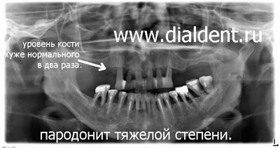 оценка состояния кости на панорамном снимке зубов
