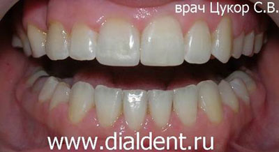 реставрация переднего зуба и отбеливание зубов