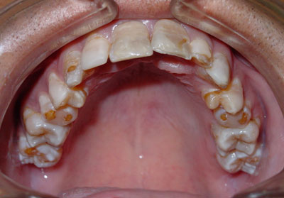 гипоплазия эмали зубов