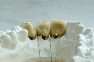протезирование зубов золотом - металлокерамические коронки