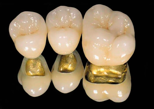 протезирование зубов золотом