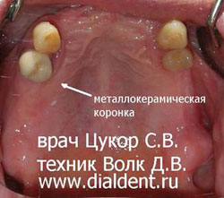 зуб перед протезированием укреплен металлокерамической коронкой