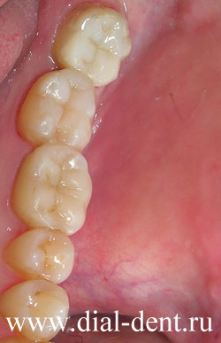 керамическая зубная вкладка во рту